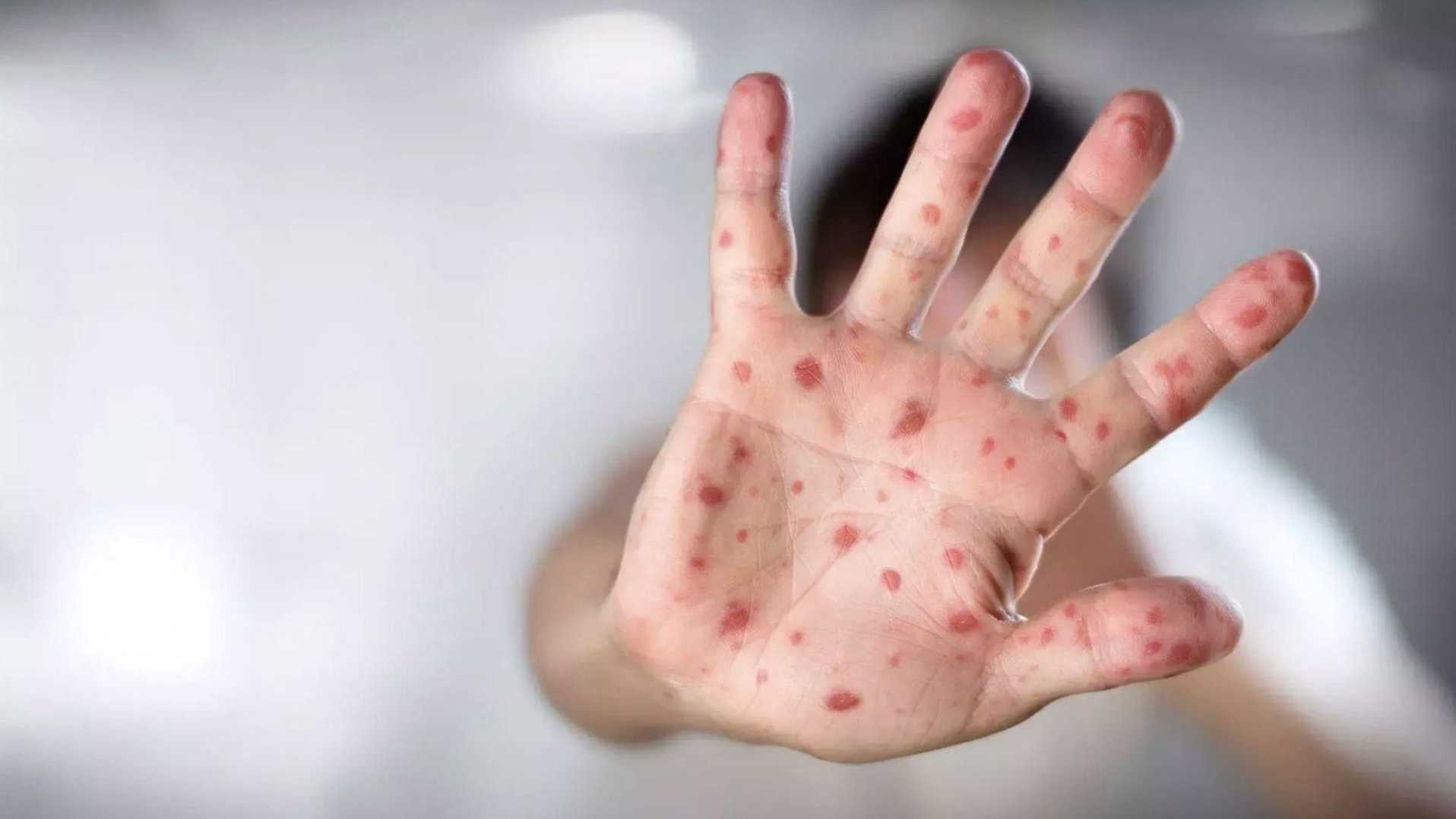 Hasta el 25 de mayo de este año, la Secretaría de Salud ha registrado 1,871 casos probables de sarampión y rubéola