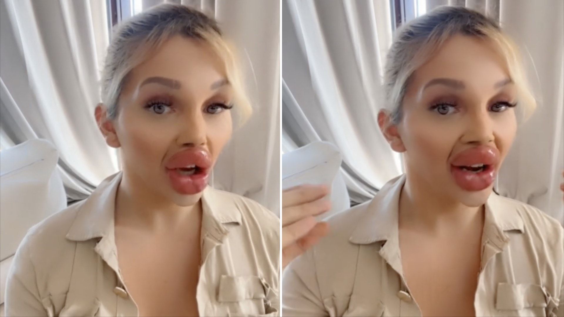 Influencer Vienna Würstel no puede comer por el tamaño de sus labios