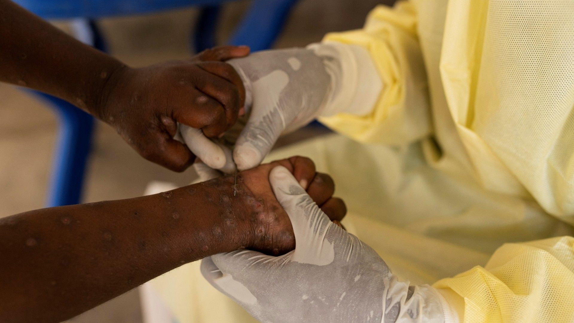 Mpox, emergencia de salud en África